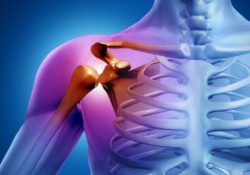 osteoartroz plechevogo sustava 250x175 - Остеоартроз плечевого сустава. Причины и лечение
